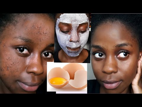 , title : 'Kuondoa CHUNUSI Usoni na MAKOVU kwa haraka | How to get rid of acne'