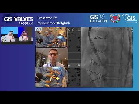 08  Mohammed Balghith   Stable and Accurate positioning of TAVR using Navitor system with Smart Seal