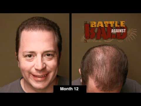 Bosley Hair Transplant Results After 12 Months (Time...