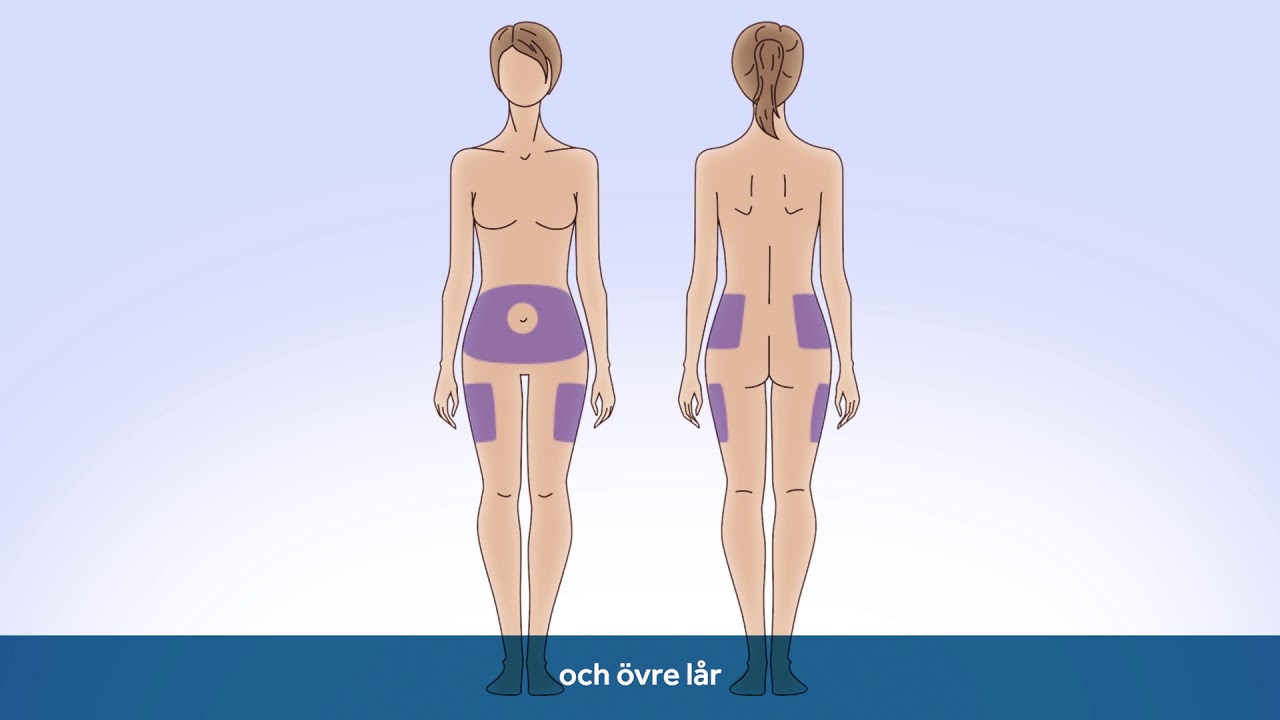 Hur appliceras Medtronic MiniMed™ Mio™ Advance infusionsset?
Nyckelfunktioner
90° mjuk Teflonkanyl Färdigladdad sättare Gömd nål före och efter användning Kan användas med både Medtronicpumpar och andra pumpmärken med luerkopplingar Det hörbara ”klicket” indikerar en säker koppling