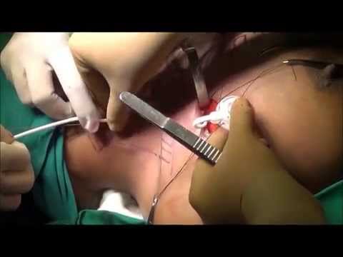 Chemoport Insertion