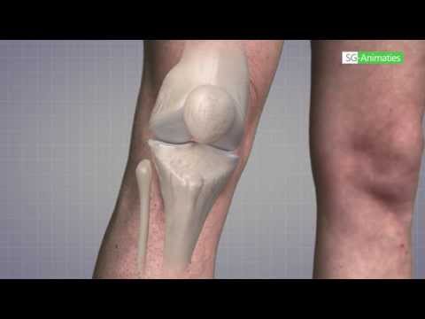 Warum habe Halsschmerzen mit Osteochondrose Osteochondrose sacro Lendenwirbelsäule 3 Grad