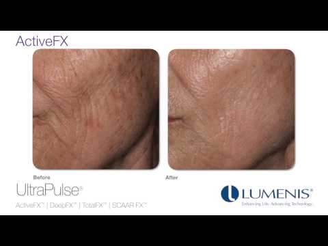 UltraPulse- Before and After Photos