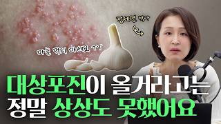 무서운 대상포진! 이 음식만은 먹지 마세요 | 정세연의 라이프연구소