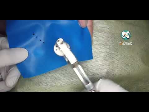 طريقة تركيب الحاجز المطاطي لعدة أسنان خلفية  Application of Rubber dam for posterior teeth