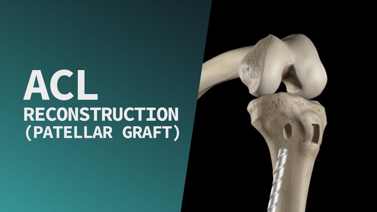 ACL Reconstruction (Patellar Graft)