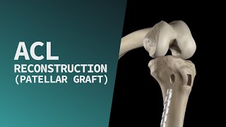 ACL Reconstruction (Patellar Graft)