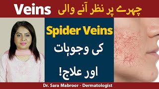 Spider Veins Kya hain? | Spider Veins on Face: Causes and Treatment in Urdu/Hindi
