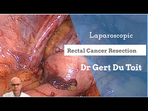 Laparoscopic Low Anterior Resection for Rectal Cancer