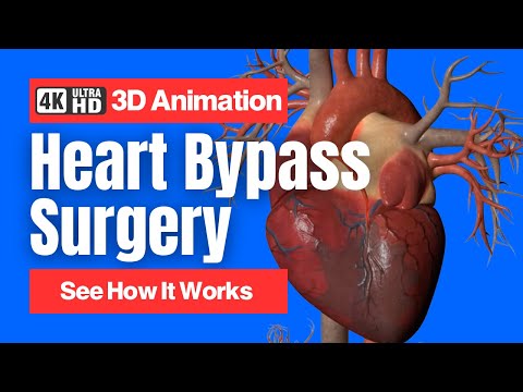 Heart Bypass Surgery - See How It Works - 3D Animation (Coronary Artery Bypass Graft CABG)