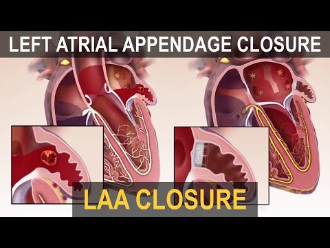 Left Atrial Appendage (LAA) Occlusion