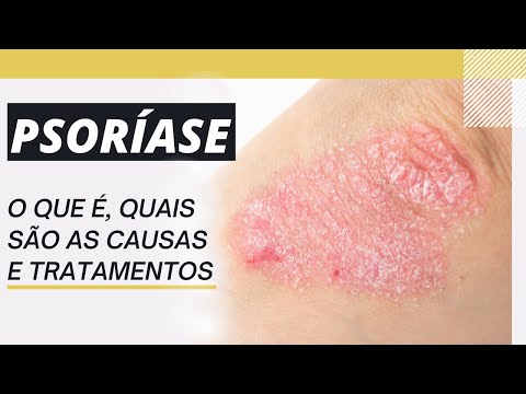 PSORÍASE - O QUE É, QUAIS SÃO AS CAUSAS E TRATAMENTOS