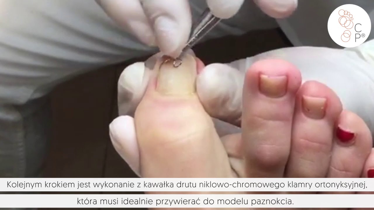 KLAMRA FRASERA | Centrum Podologiczne