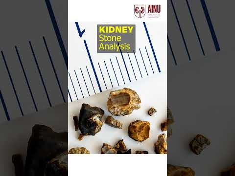 Are Kidney Stones Forming Even After Surgery? | Dr. Subhash Chandra Bose | AINU Hospitals