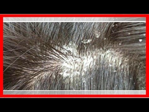 How to get rid of cat dandruff