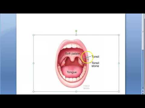 ENT TonsilloLITH Tonsil Stone tonsilloliths stones