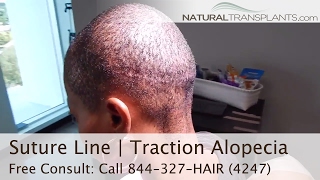 Hair Doctor Shows off Suture Line | Dr. Harold Siegel with Traction Alopecia Patient