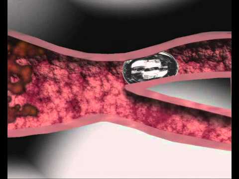 La formation des bulles