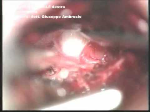 Vita articolazioni litorale balsamo Esercizio di hip coxartrosi grado 2-3