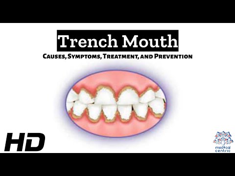 Hyperdontia Causes Signs and Symptoms Diagnosis and Treatment