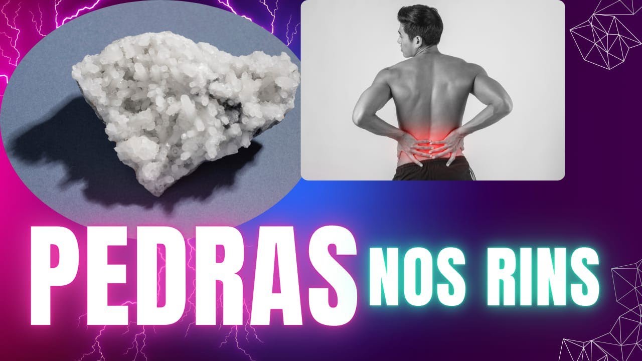 Como acabar com as PEDRAS NOS RINS definitivamente. como tratar, tipos , causas . saiba tudo.