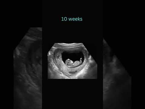Sneak Peek: 10 Weeks Pregnancy Ultrasound! #baby #ultrasound #positivebirth #pregnant  #babyscan