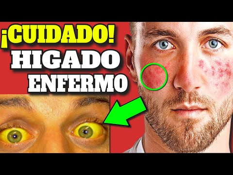 , title : '¡CUIDADO! ESTOS SIGNOS de ALARMA INDICAN que TU HIGADO está MUY ENFERMO'