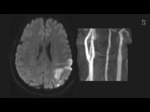 Stroke can strike at any age