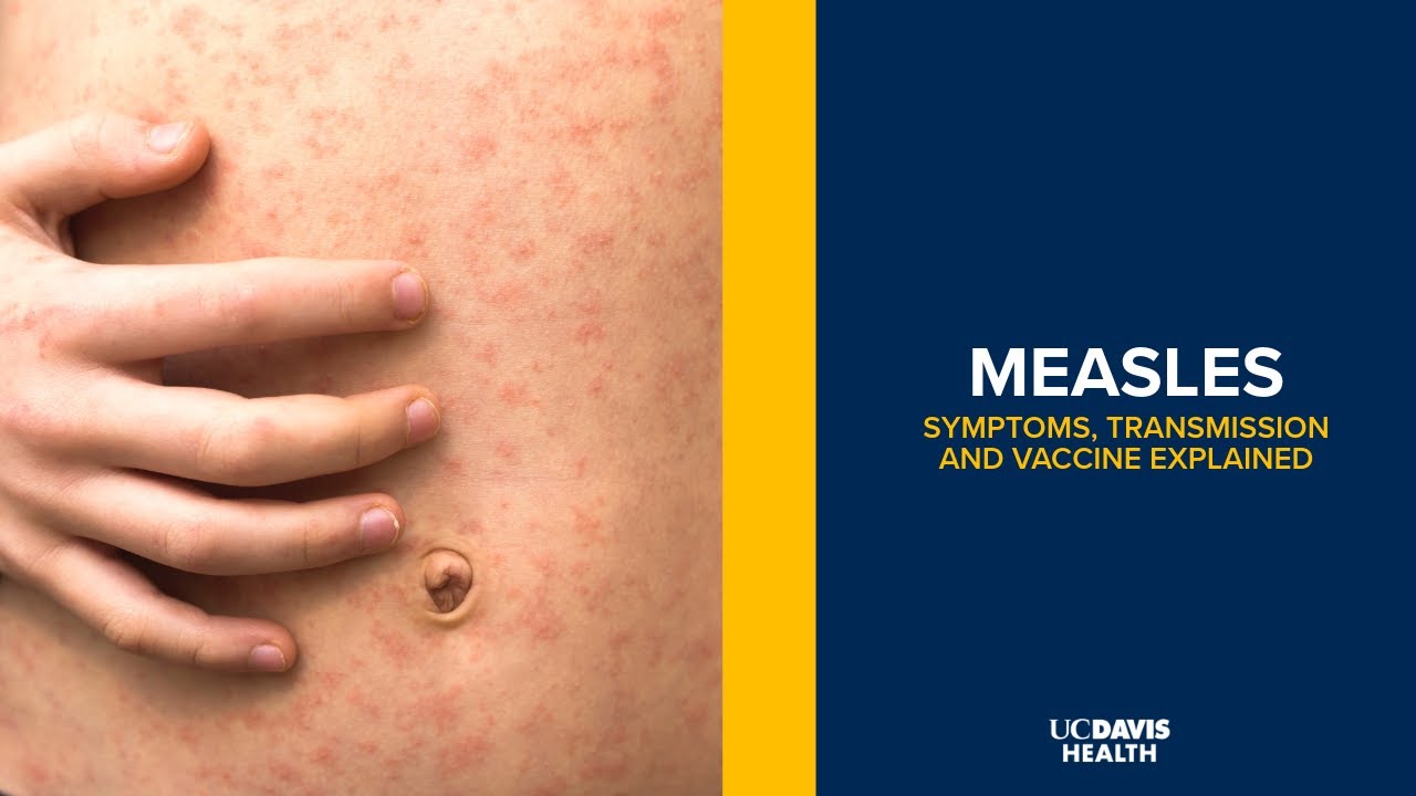 Thumbnail preview of Measles: What Parents Need to Know