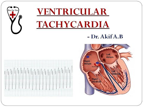 Ventricular Tachycardia and its differentiation from SVT with Aberrancy : Dr. Akif Baig