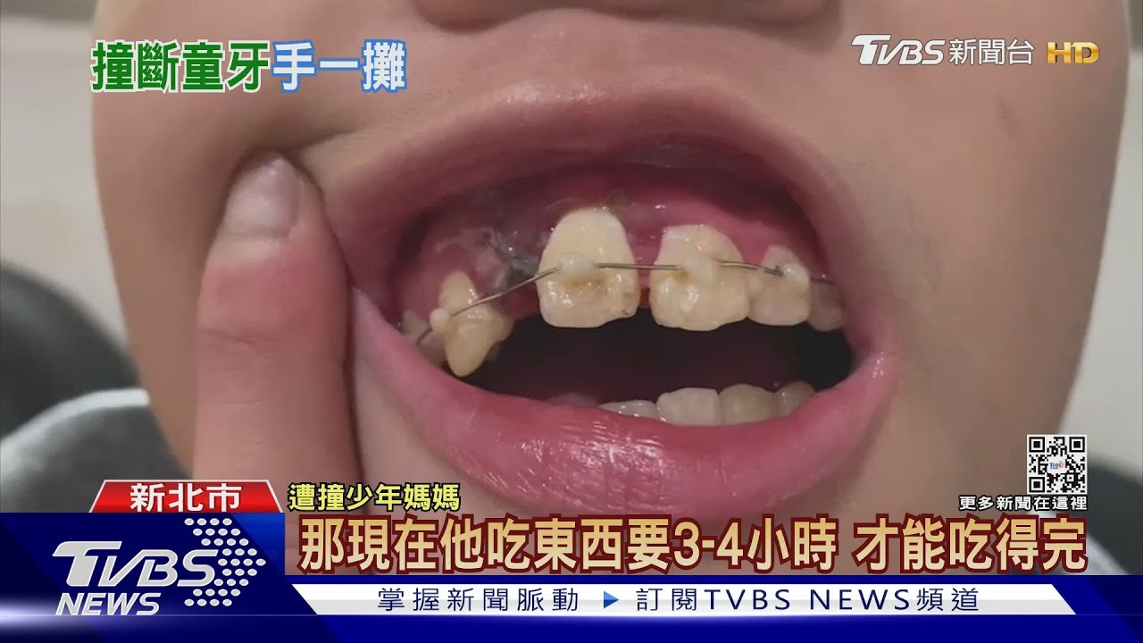 走路邊遭機車衝撞! 國一生「門牙」被撞斷