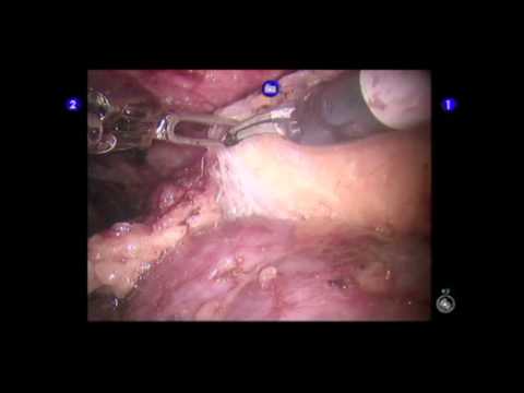 Demonstration of Renal Perfusion During Robotic Partial Nephrectomy