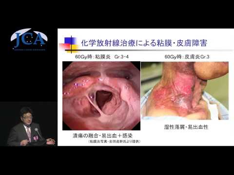 栄養学科 講演3「はな・くち・のどのがんの話」松浦　一登　（宮城県立がんセンター・頭頚科）