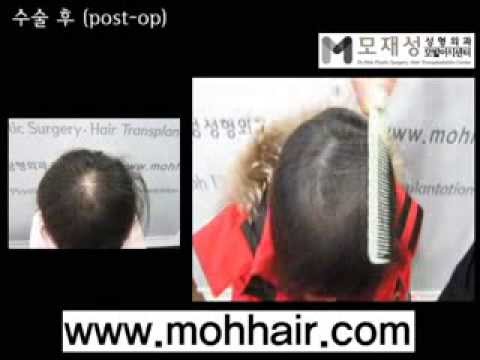 Scalp Micropigmentation by Dr. Moh