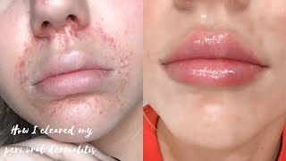 HOW I CLEARED MY PERIORAL DERMATITIS