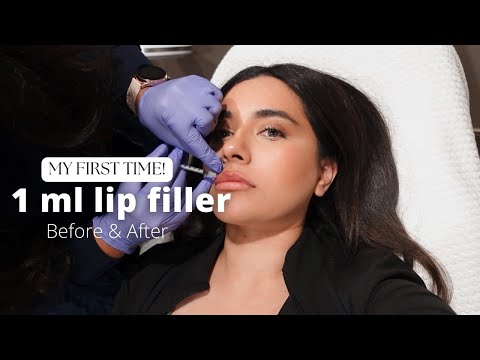 ICH HABE ZUM ERSTEN MAL LIPPENFÜLLUNGEN BEKOMMEN! - 1 ML