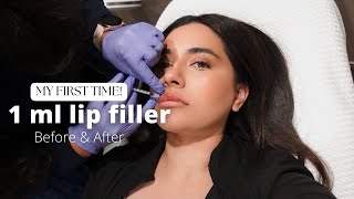 I GOT LIP FILLERS FOR THE FIRST TIME! - 1ML