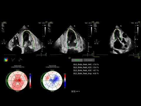 GLS Global longitudinal strain LV, RV, LA- amyloidosis