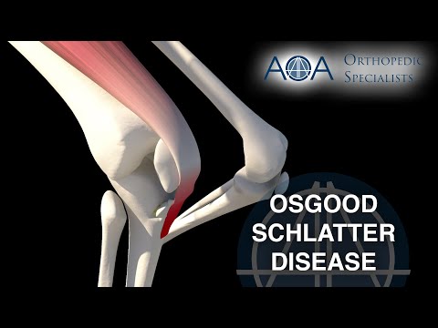 AOA Orthopedic Specialists - Osgood-Schlatter Disease