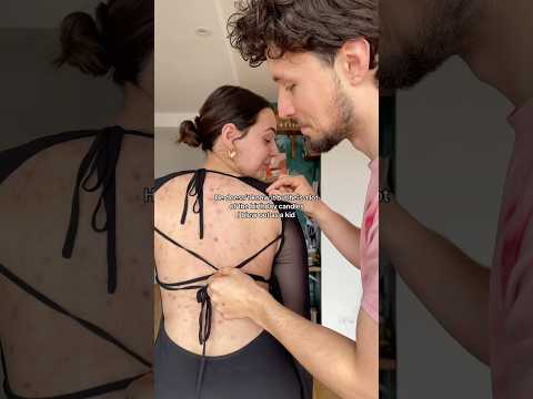 Acne or not, you are and will be loved for who you are❤️‍🩹 #acne #couple #makeup #grwm #trending