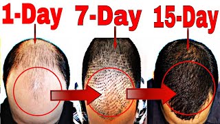 How to Stop Hair Fall Naturally | Grow Hair Faster(Men & Women)