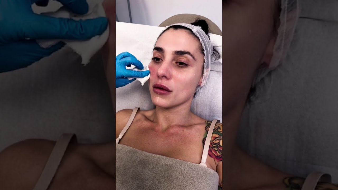 Trattamento Biorivitalizzante con Profhilo viso e collo associato a Massaggio Kobido