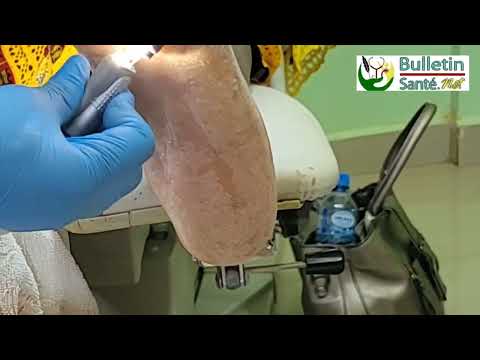 Pied diabétique: Voici comment se passent les soins préventifs