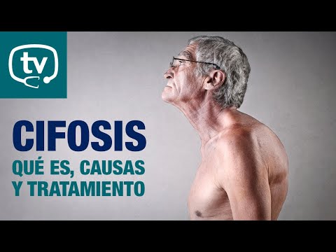 Cifosis, ¿qué debes saber?