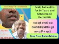 Scalp Folliculitis for 28 Years and Seborrhoeic Dermatitis Getting Cured