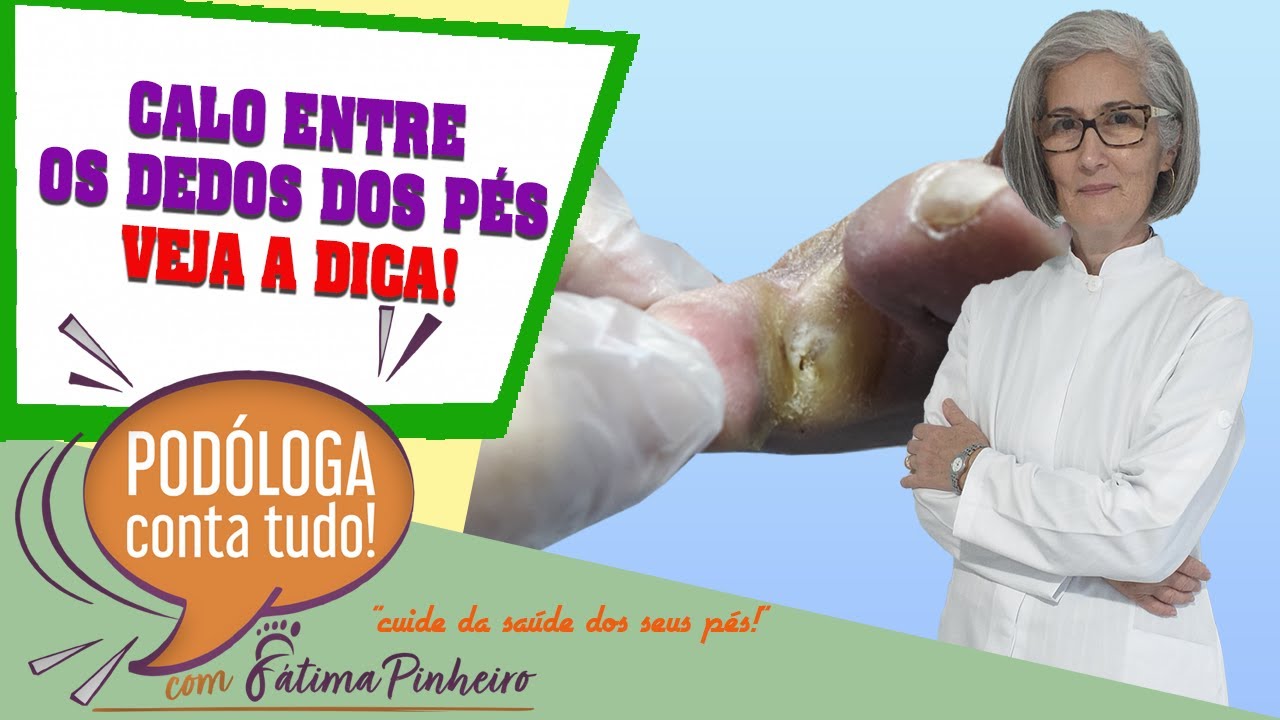 CALO ENTRE OS DEDOS DOS PÉS - VEJA A DICA!