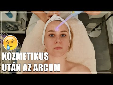 Arcégés és vörös foltok az arcon a kozmetikus után, Mi a rosacea?