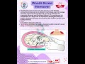 👩‍🍼Woods Screw maneuver- Used in Labour normal delivery #norcet #nursing #sgpgi #labour #aiims #obs