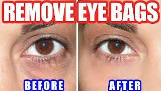 How to Get Rid of Bags Under Eyes – Best Way to Remove Under Eye Bags Naturally at Home