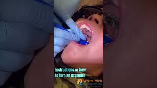 How to turn your expander | White Rock Orthodontics Dallas, Texas